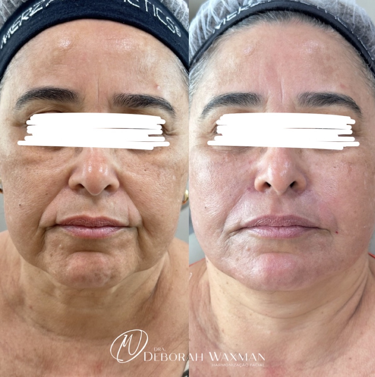 Antes e depois — Full Face com avaliação global do rosto