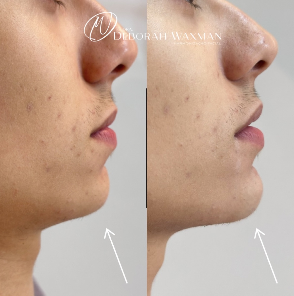 Antes e depois — harmonização do contorno mandibular