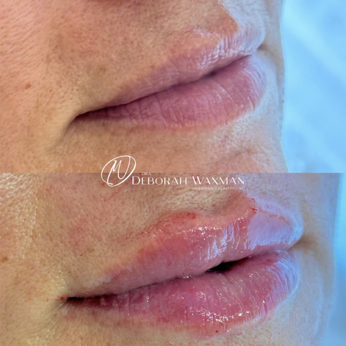 Antes e depois — harmonização labial
