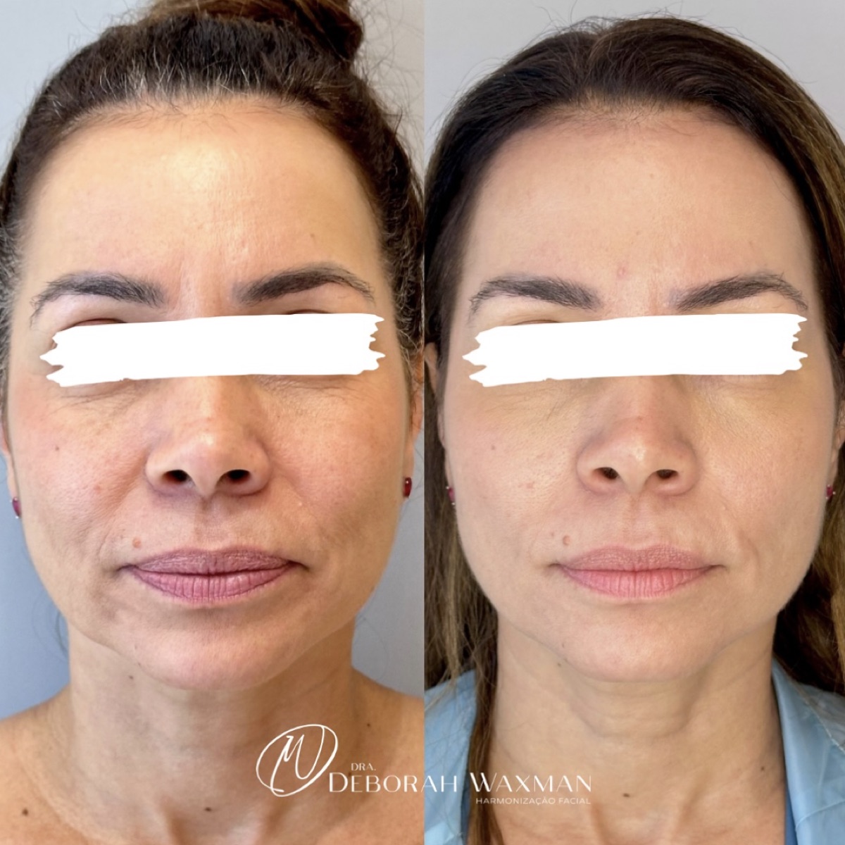 Antes e depois — harmonização facial Dra. Deborah Waxman