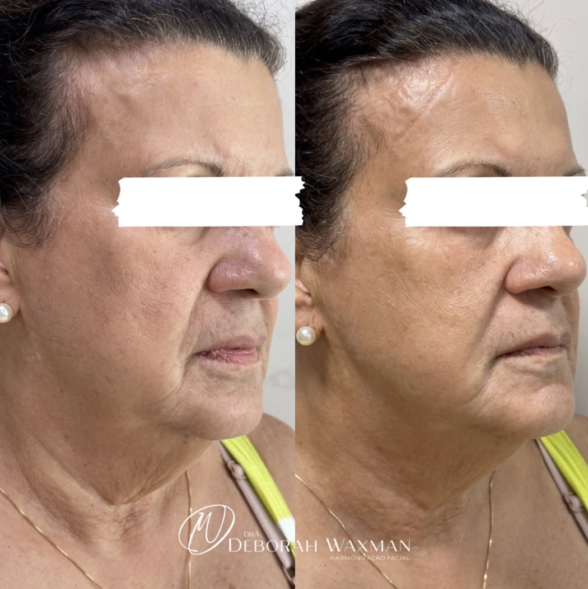 Antes e depois — rejuvenescimento facial multicamadas