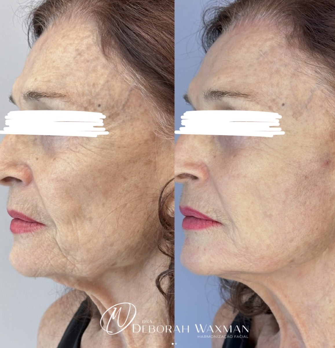 Antes e depois — protocolo de qualidade da pele