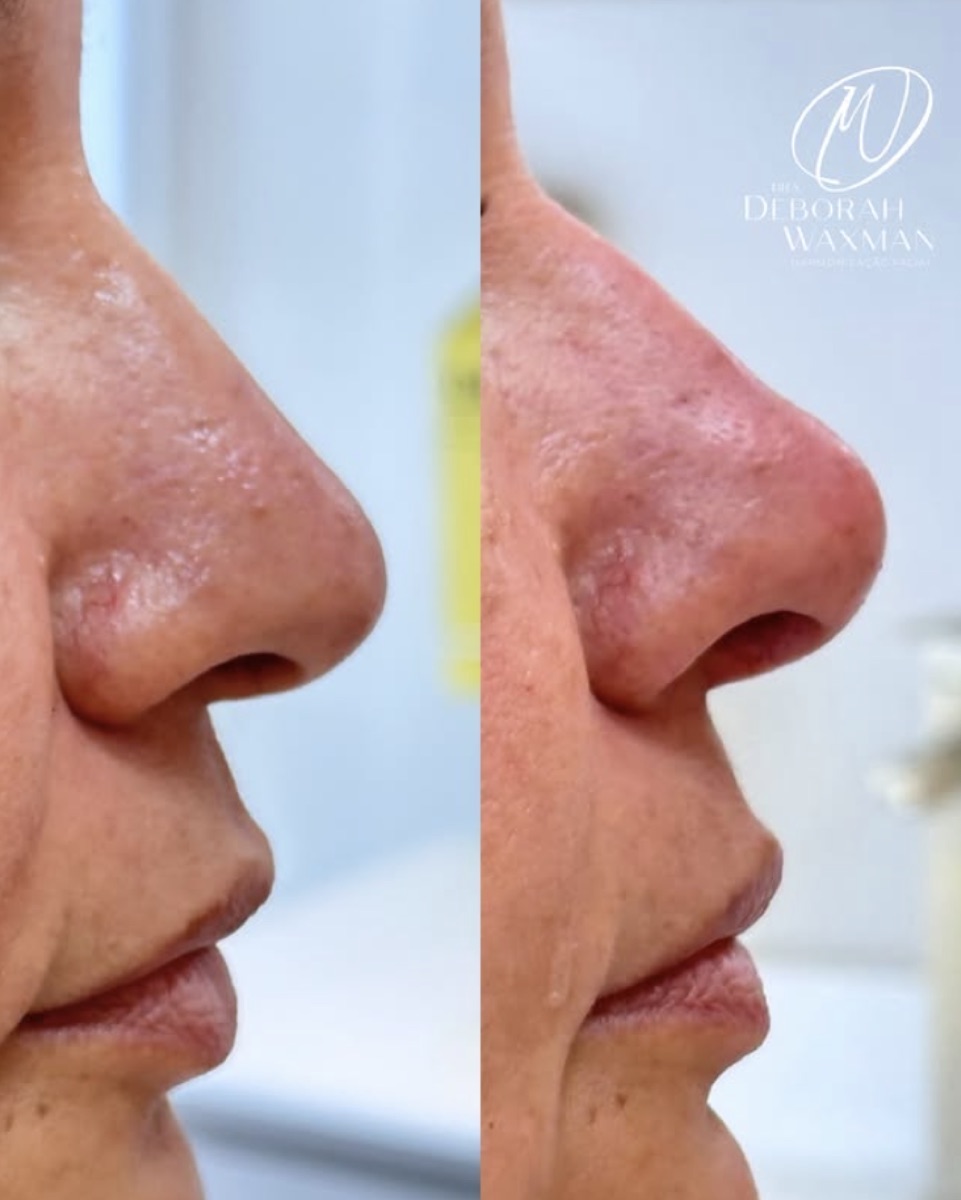 Antes e depois — refinamento do contorno do nariz