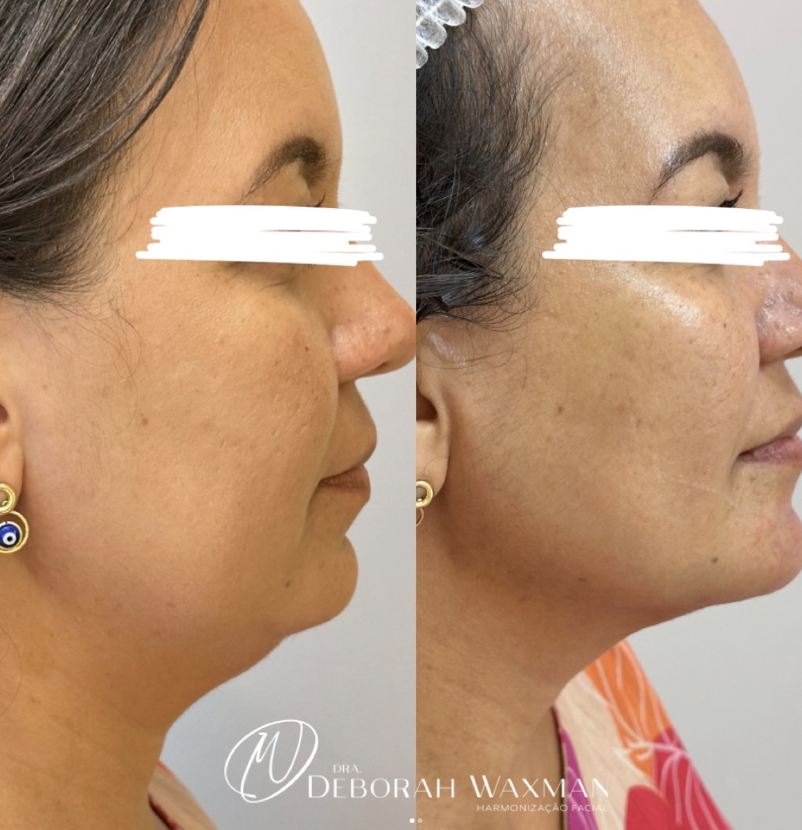 Antes e depois — definição do mento e perfil mandibular